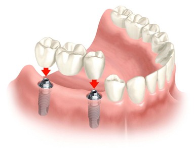 Prótese Dentária
